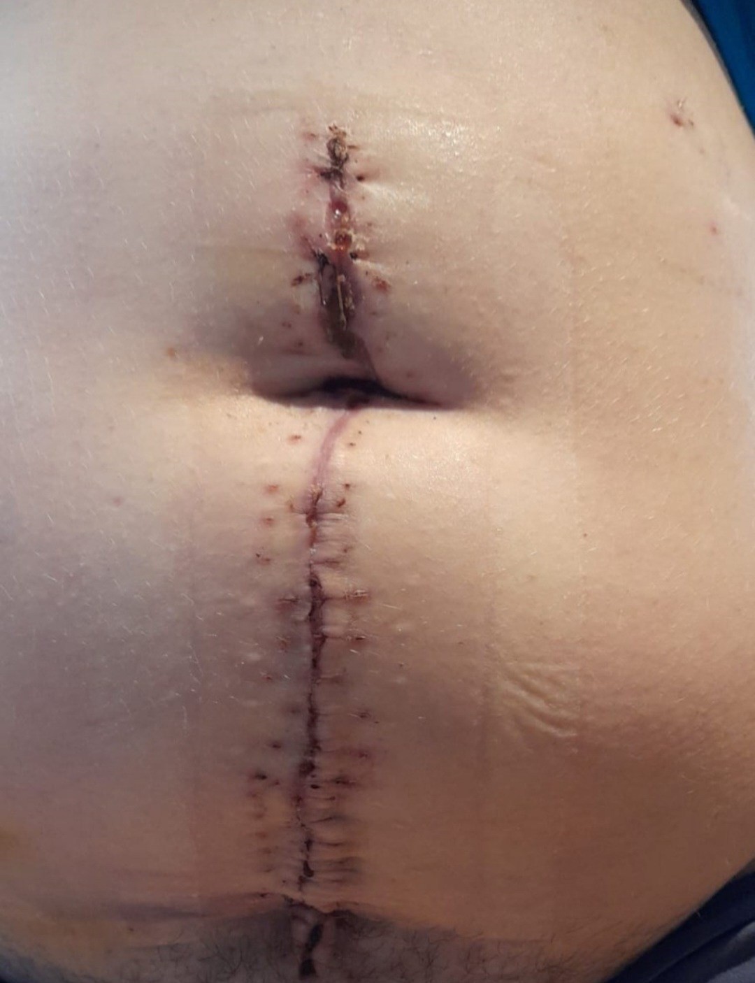 After the 2022 bowel resection