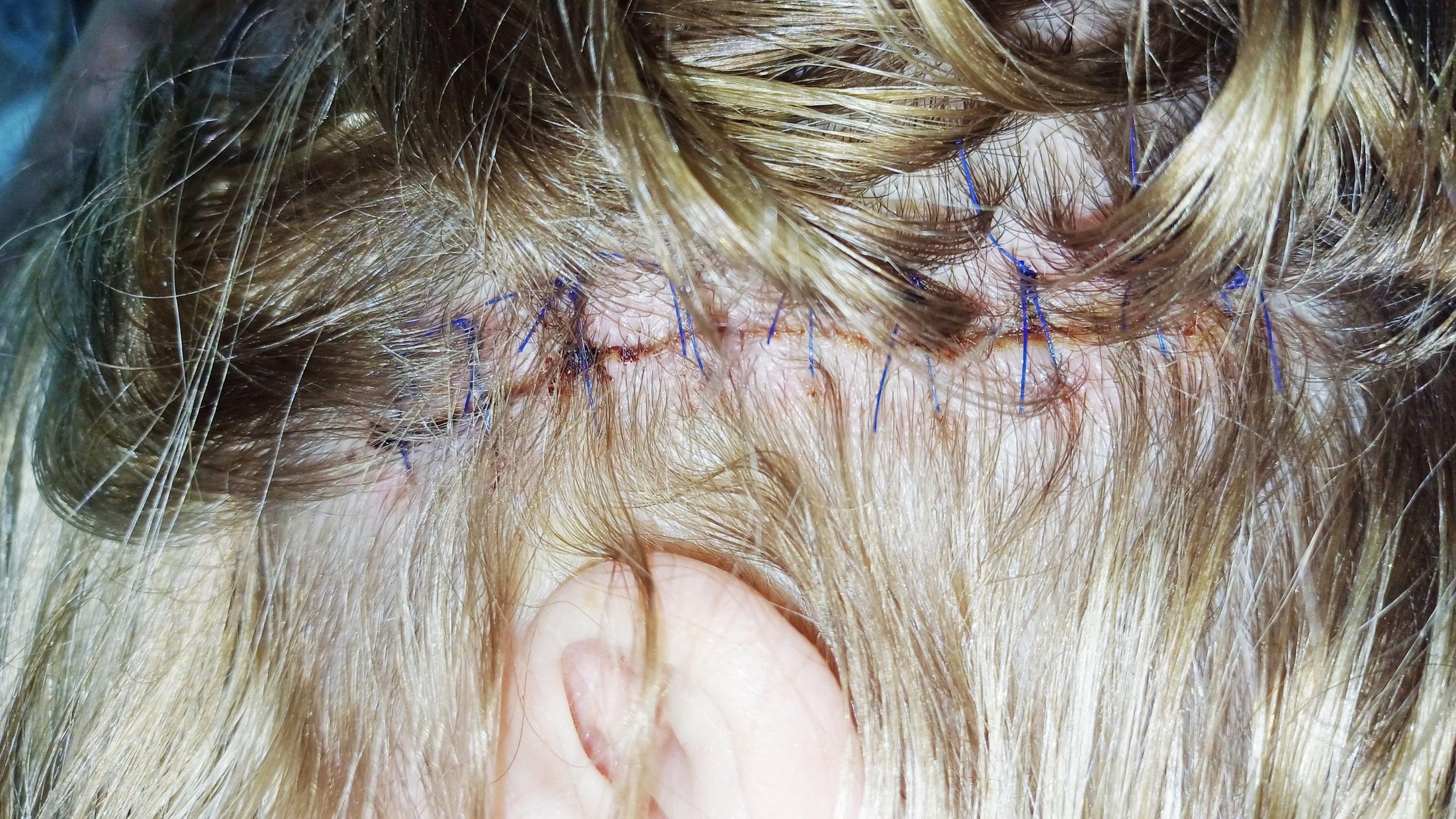 Brain surgery incision